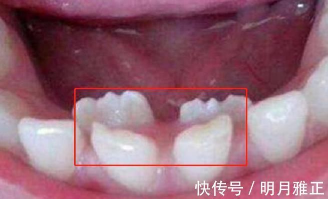 智齿|6岁男娃长“双层牙”,老人的“坏习惯”害了娃,你家有这习惯吗