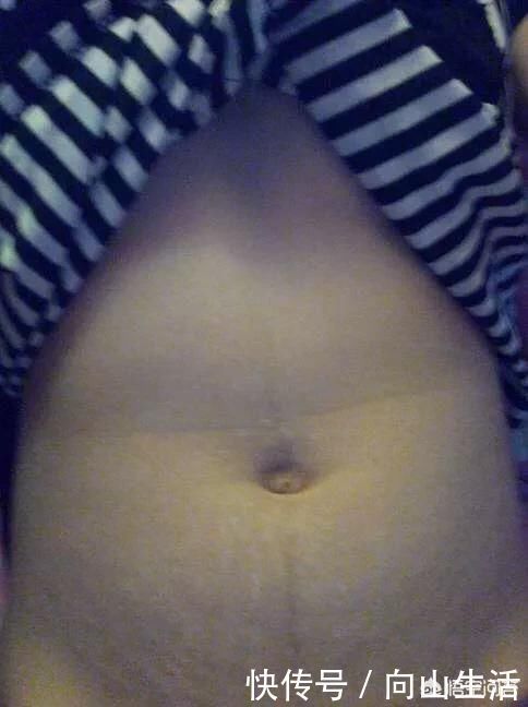 肚子|准妈妈肚子上为啥会有妊娠线?妊娠线会一直存在吗?