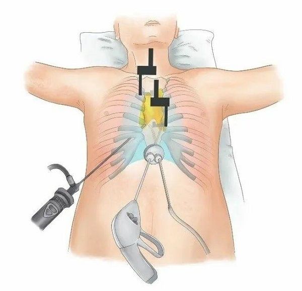 切口|把胸骨悬吊起来做手术？这个“神器”延展胸腔镜手术适应证