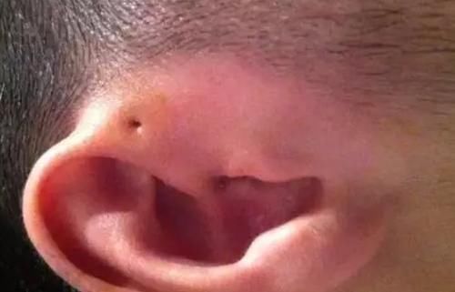 富贵洞|你家宝宝耳朵上有“富贵洞”吗?如果有,家长们可要多留心了