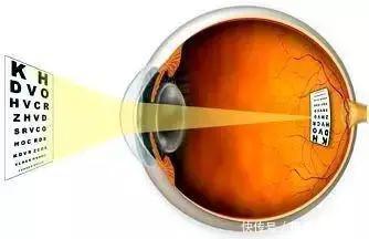 屈光度|让眼屈光发育可控,便是掌握了“近视”终结者