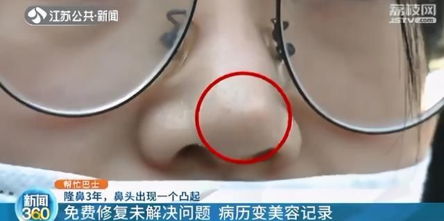 女子隆鼻后长出硬疙瘩 想退钱却找不到人
