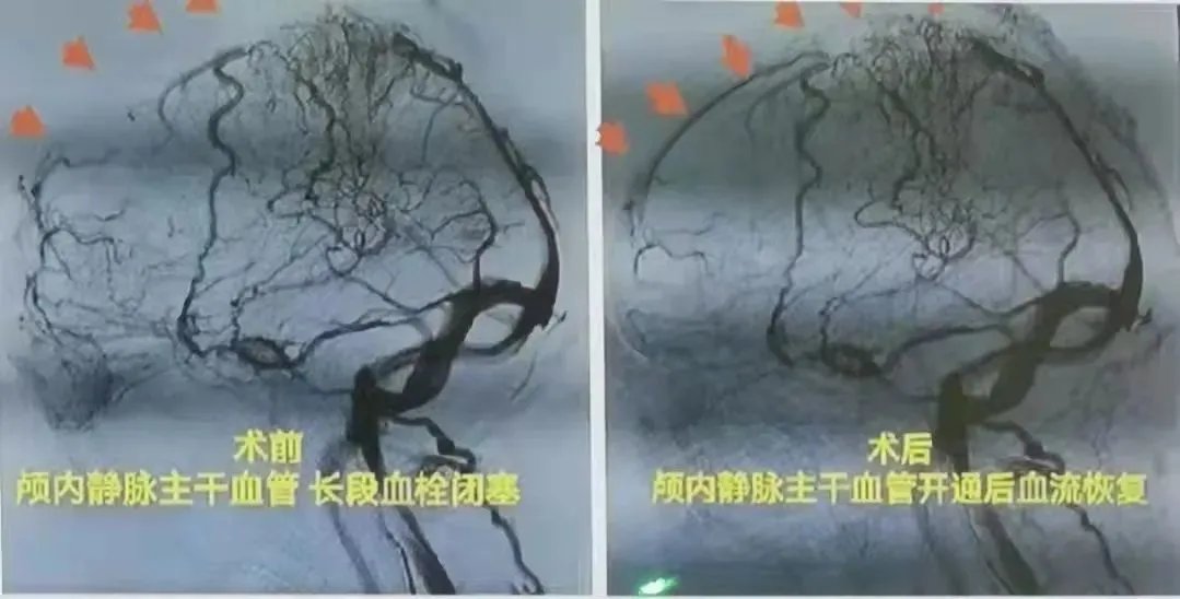 小强|30岁小伙突然抽搐、昏迷不醒!只因狂喝这个年轻人爱的