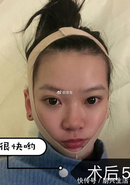 下颌角|关于下颌角手术，大家都会担心后遗症有哪些？有后遗症应该怎么办？