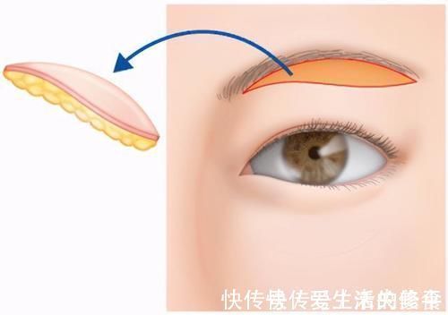 眼睑 提眉手术后，会不会留下睡觉“闭不上眼”的后遗症？医生告诉真相