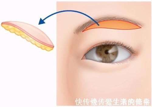 眼睑 提眉手术后,会不会留下睡觉“闭不上眼”的后遗症?医生告诉真相