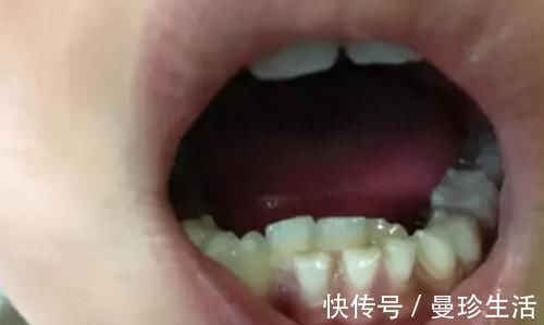 牙齿|2岁宝宝长出一口“鲨鱼牙”,宝妈痛哭求助,医生无奈:自作自受