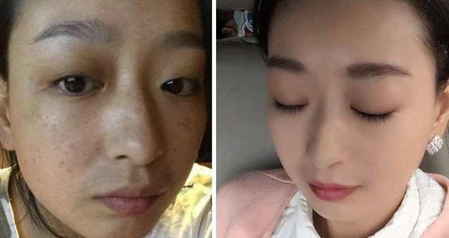 红霉素软膏加一物敷脸,15天美白肌肤淡化色斑,赶紧去备上一支