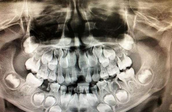 牙痛|6岁的孩子牙痛不见了,他被送到医院检查后,医生责备他的父母无知