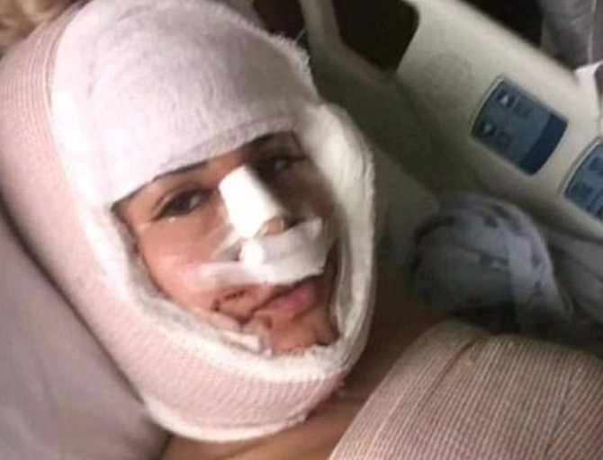 隆鼻 女子花重金整容,一年经历13次整容手术,整容前后判若两人