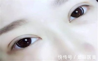 注意事项 割双眼皮都有哪些术前术后注意事项,你都知道吗?