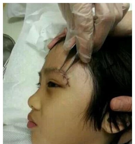 劉海|錄《爸爸去哪兒》造成眼角永久性傷害,13歲費曼露無劉海正臉