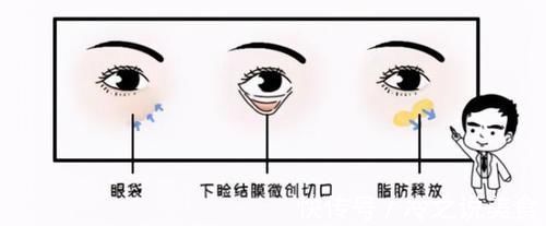 手术|32岁哺乳期女生,分享自己的求美经历:甩掉眼袋和泪沟不烦恼