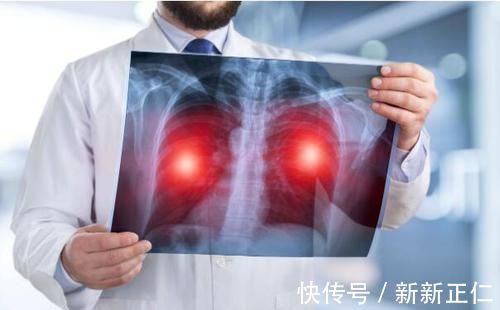 检查|身体出现这5种症状,或暗示你肺癌将至,趁早检查