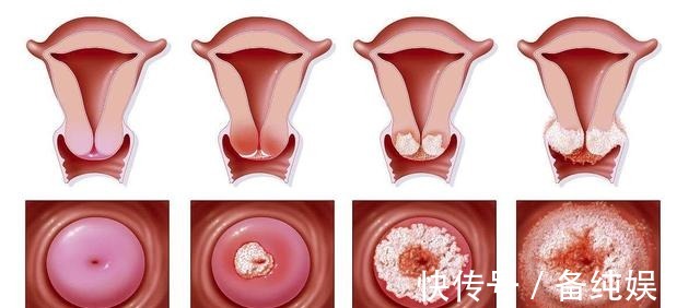 炎症|从炎症到癌症,警惕以下7种炎症成为癌症“帮凶”
