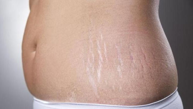 怀孕|孕期不想长妊娠纹,孕妈需要做好这4点,产后肚皮依然如初