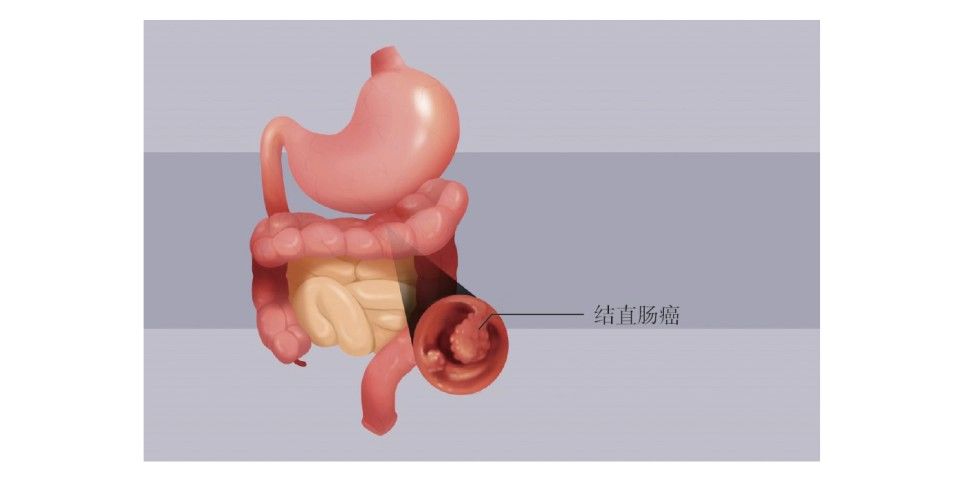 诊断性|体检查出便便有血就是肠癌吗？身体出现哪些症状要警惕结直肠癌？