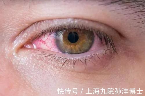 泪液 孙沣博士:双眼皮手术后,眼睛总爱流泪是正常情况吗?