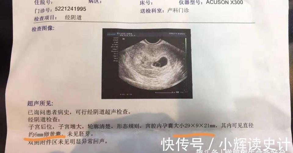 胎儿|怀孕6周,做B超还没看见胎心胎芽,是该坚持还是放弃?