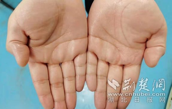  手汗症|小伙手掌常年“汗如雨下”一台胸腔手术解决困扰