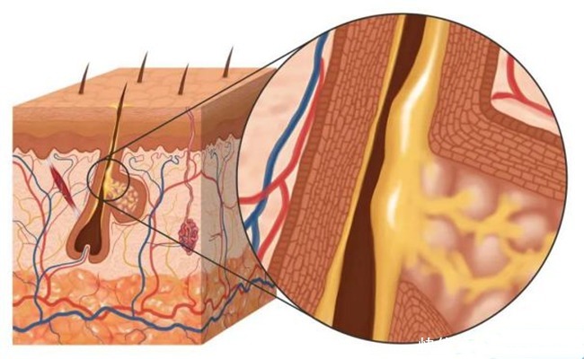 油性肌肤应该怎样护肤？油性肌肤护理的二三事