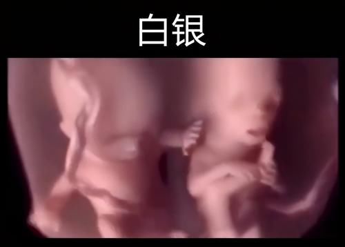 发育不良|双胞胎在子宫里有多“热闹”？医生：打架争地盘都是常事