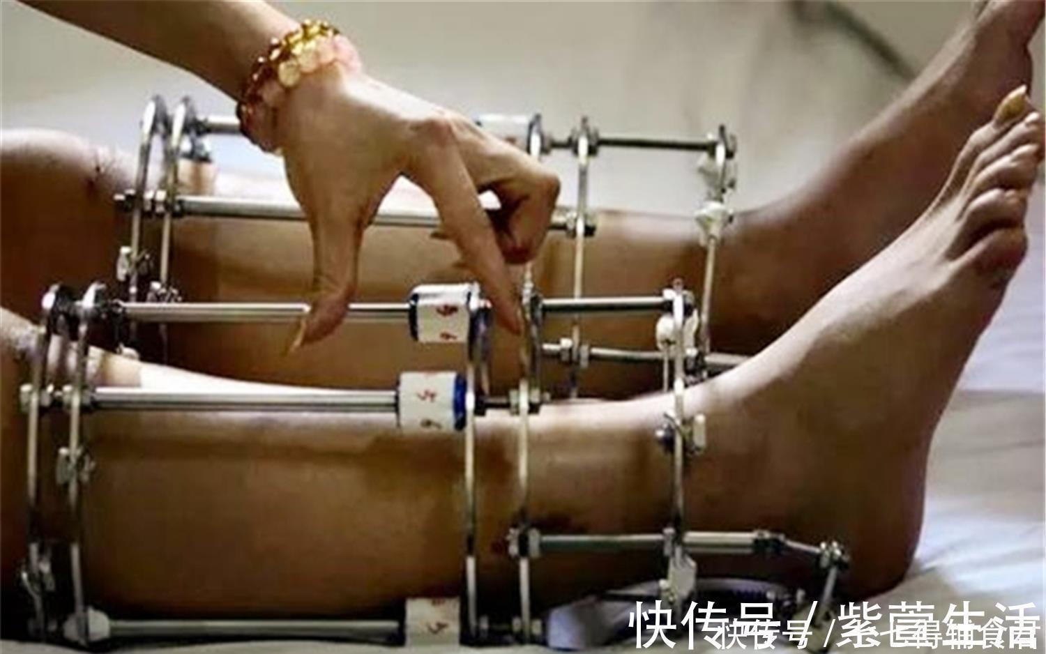 网友们|男子花费58万“拉骨”,只为增高5厘米,网友们大呼无法理解