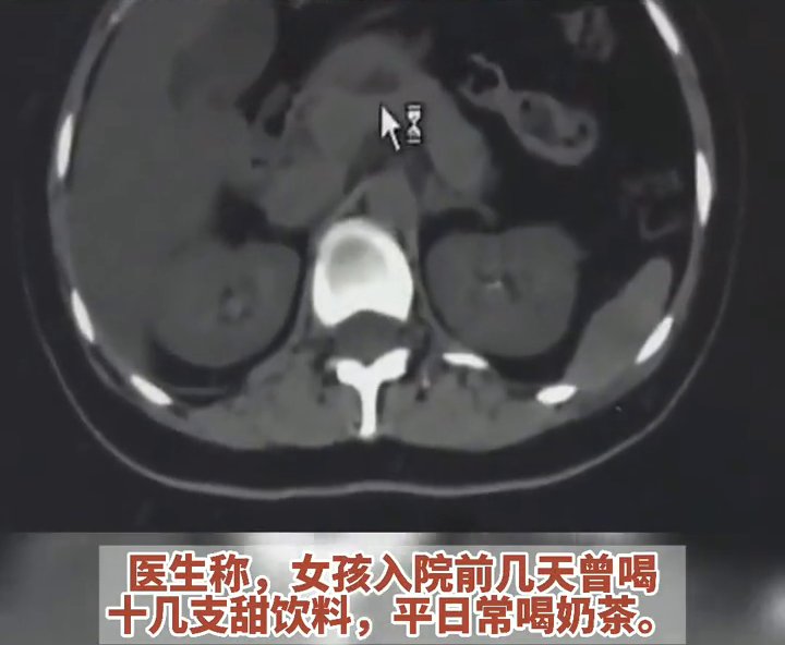 icu|平日常喝奶茶！29岁女生被诊断为爆发型糖尿病，住进ICU！