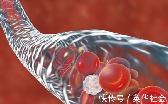 高血压|血压高的人，身体若有''1麻1红1疼''，尽早就医，警惕脑出血