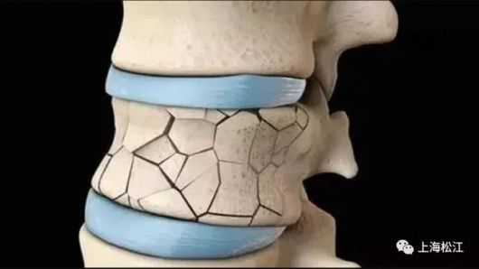 治疗|你了解脊椎压缩性骨折吗？如何治疗？松江医生来解答