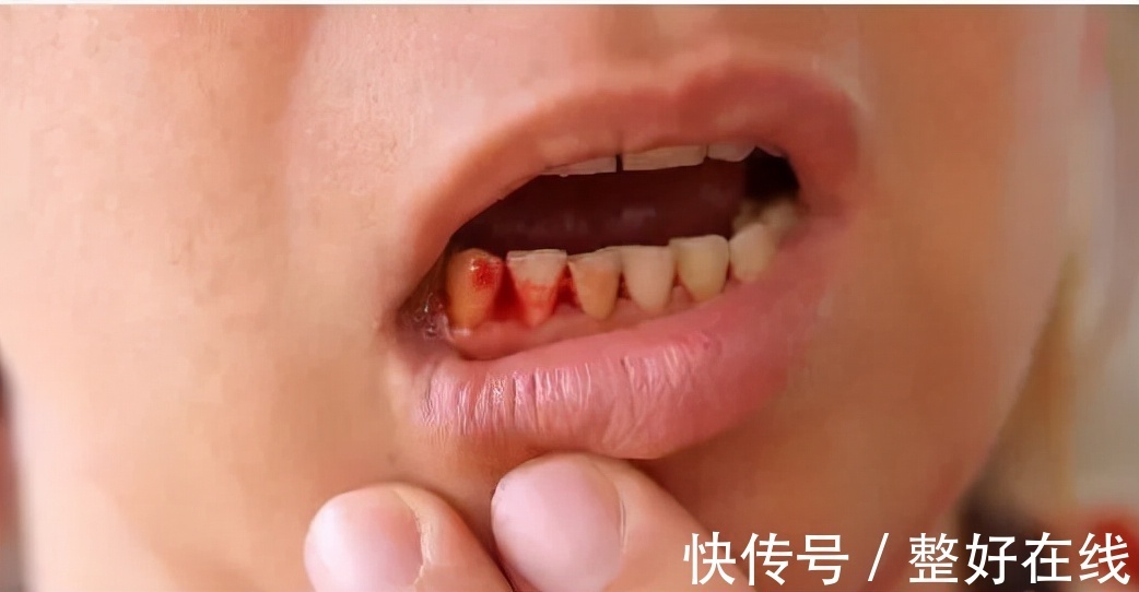 恶化|提醒肝炎患者:身体出现3个信号,肝炎正在转变为肝癌!不能忽视