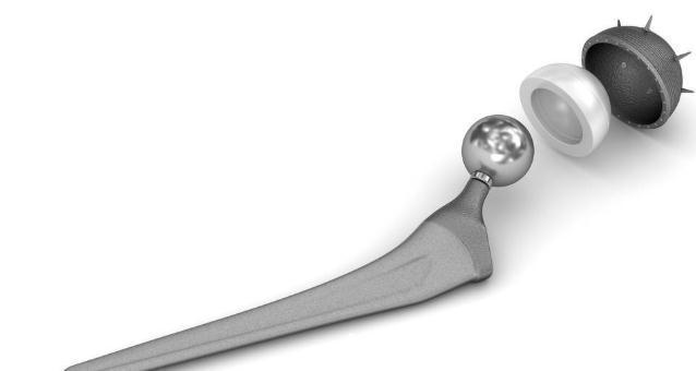 关节炎|晚期关节炎能靠人工关节置换术夺回健康?医生讲明不早用的理由