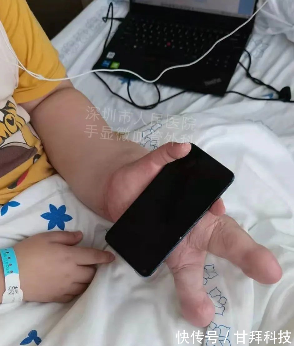 男孩|得了这病,12岁男孩手指比香蕉还粗!7种常见的手部畸形,家长们要注意