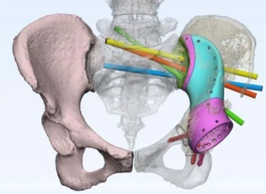 患者|云南省肿瘤医院成功开展云南省首例个体化3D打印钛合金半骨盆假体精准重建术