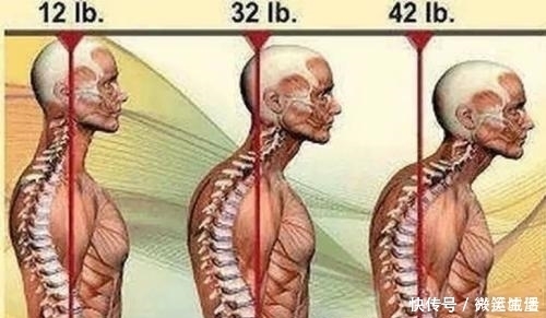 酸疼|颈椎安康:得了颈椎病不要怕,四个防护方法助您保护您的颈椎