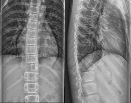 椎体|脊柱常见肿瘤及肿瘤样病变的几种影像学表现，你都见过吗？