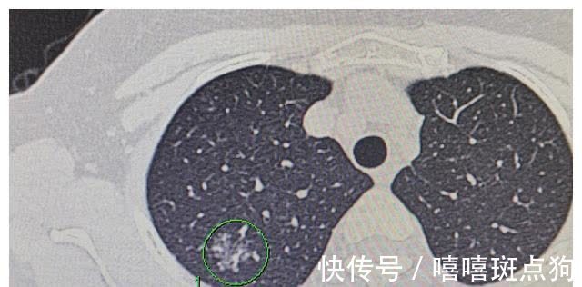 结节|磨玻璃肺癌都是高分化腺癌吗？磨玻璃结节发展到哪种腺癌都有可能