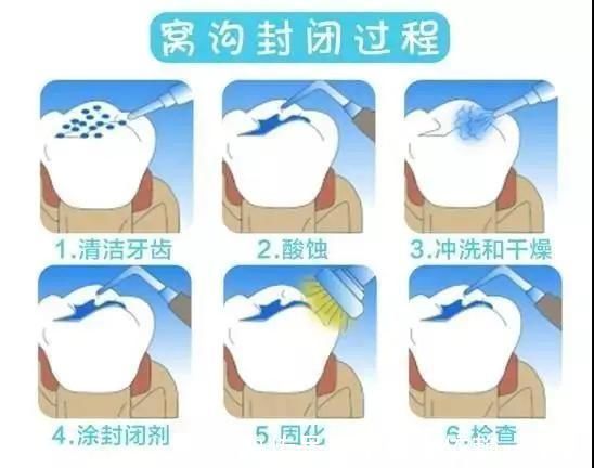 龋齿|妈妈们注意了,6成儿童蛀牙都发生在这牙上!