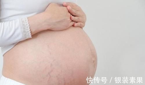 体重|“毁容式”怀孕之妊娠纹:10个孕妈9个长纹,教你咋应对咋预防