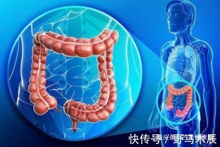 肠道|放屁多的人,容易得肠癌医生提醒以下几类人才最该担心