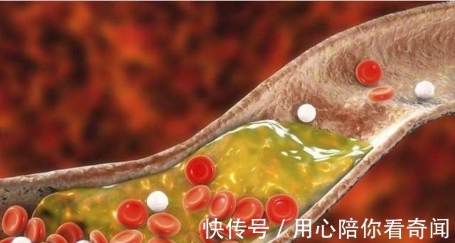 高血脂|血脂高的人有哪些表现呢?建议大家少吃这几种食物