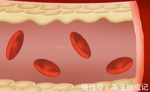 支架|62岁教授，血管狭窄从90%降低到70%，支架都免了，患者分享方法