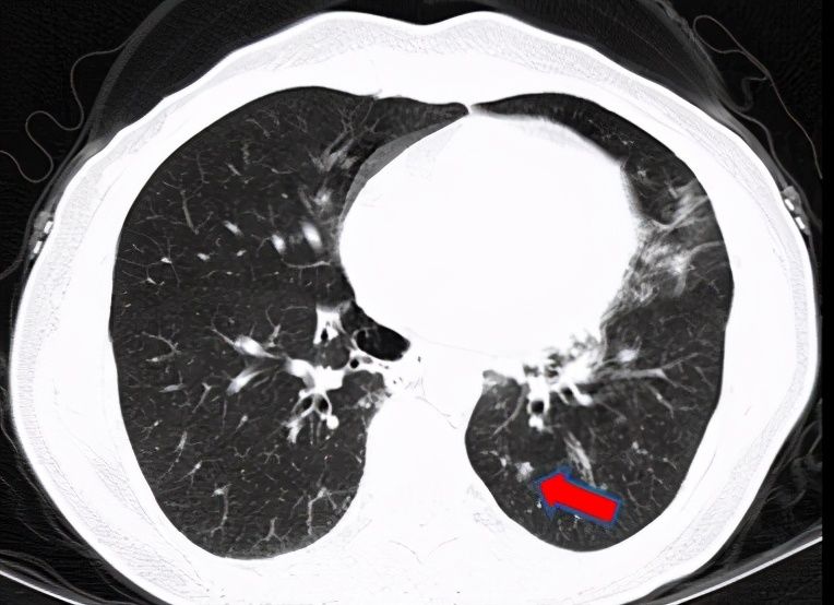 结节|刀下“留肺”!容易误认为癌性“肺结节”的8种感染