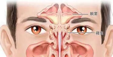 鼻窦炎反反复复 别怕 专家告诉你该怎么办 快资讯