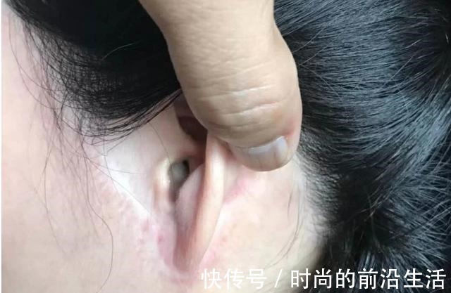 求美者 做了“假拉皮”手术,危害有多大!