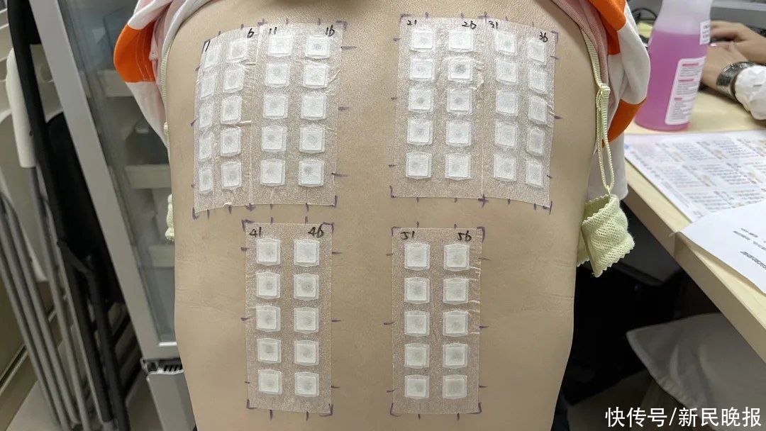 骆肖群|对紫外线过敏?不是“矫情”!这些变态反应最严重会致休克...