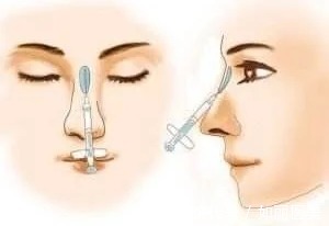 注射隆鼻 隆鼻手术一般多少钱?隆鼻能保持多久?