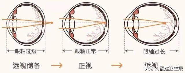 真性近视|5岁孩子两次查视力结果截然相反！眼科专家：查远视储备，帮你“掐指”预测近视情况