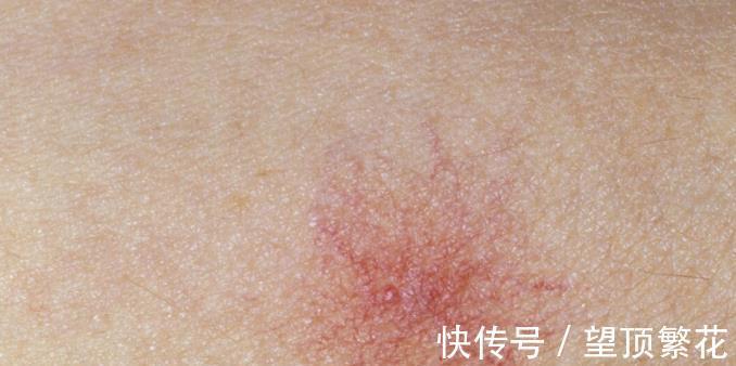 胆汁酸盐|皮肤经常瘙痒,别以为只是皮肤过敏,还要注意肝功能检查,多留意