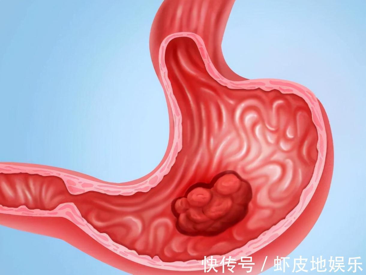 胃溃疡|我国癌症误诊率约在30%左右,提醒:3种癌症易被误诊,要重视